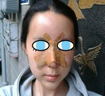 北京八大處整容醫(yī)院膨體隆鼻案例分享~