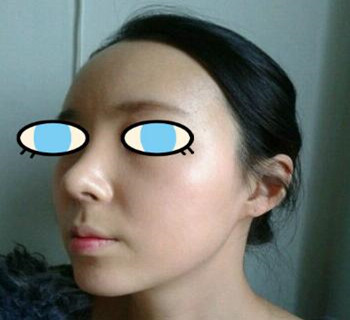 北京八大處整容醫(yī)院膨體隆鼻案例分享~