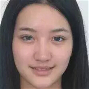 去年做的注射B****微整形，你們看看恢復(fù)前后的對比照片~~~