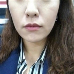 自體脂肪填充去法令紋一個星期了，分享我的恢復對比照片哦~~