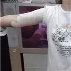 手臂吸脂手術八個月了，看看我的前后對比果圖片吧~~