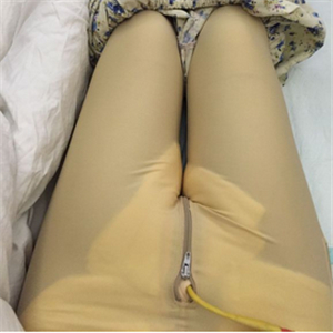 大腿部吸脂減肥一個(gè)月了，曬一下恢復(fù)過(guò)程和對(duì)比照片哇~~