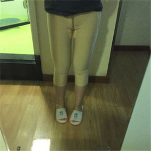 大腿部吸脂減肥一個(gè)月了，曬一下恢復(fù)過(guò)程和對(duì)比照片哇~~