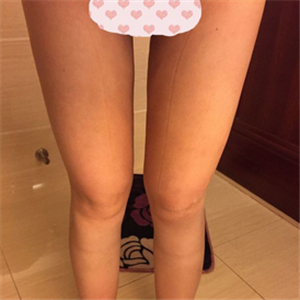 大腿部吸脂減肥一個(gè)月了，曬一下恢復(fù)過(guò)程和對(duì)比照片哇~~