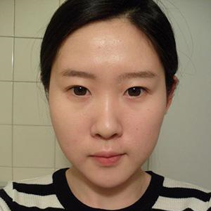 看我自體軟骨墊鼻尖恢復(fù)過程的照片，前后對比差別有點大呢~