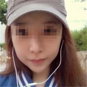 伊萊美做磨骨整形手術(shù)半年多了，分享下恢復(fù)過程照片哦~~~