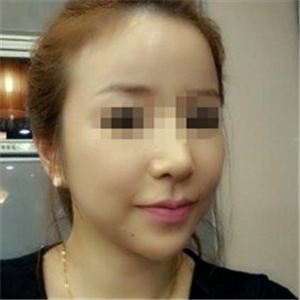 伊萊美做磨骨整形手術(shù)半年多了，分享下恢復(fù)過程照片哦~~~