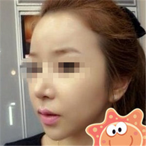 伊萊美做磨骨整形手術(shù)半年多了，分享下恢復(fù)過程照片哦~~~