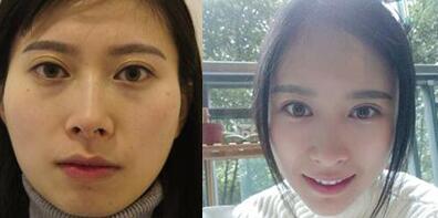 大腿吸脂做自體脂肪面部填充三個(gè)月的前后對比照片