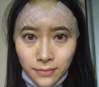 大腿吸脂做自體脂肪面部填充三個(gè)月了，分享給大家