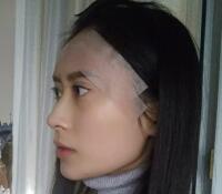 大腿吸脂做自體脂肪面部填充三個(gè)月了，分享給大家