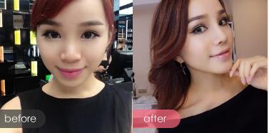 隆鼻整形前后對比圖