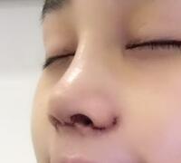 隆鼻整形真實案例恢復(fù)過程分享