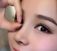 隆鼻整形真實案例恢復(fù)過程分享