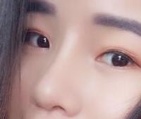 自體軟骨隆鼻手術(shù)果和恢復(fù)過程圖分享