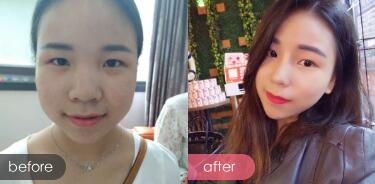 隆鼻整形——自體耳軟骨隆鼻，隆鼻前后對(duì)比圖