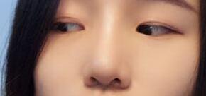 自體軟骨隆鼻手術(shù)果和恢復(fù)過程圖分享