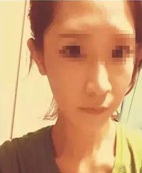 【20天康復(fù)記錄】隆鼻+面部脂肪填充，遇見(jiàn)更美的自己