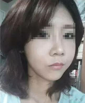 【20天康復(fù)記錄】隆鼻+面部脂肪填充，遇見(jiàn)更美的自己