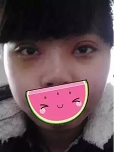 【真人案例】雙眼皮手術(shù)后，見(jiàn)證我的美!