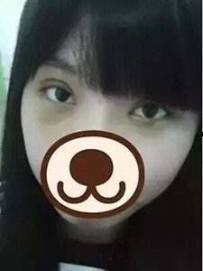 【真人案例】雙眼皮手術(shù)后，見(jiàn)證我的美!