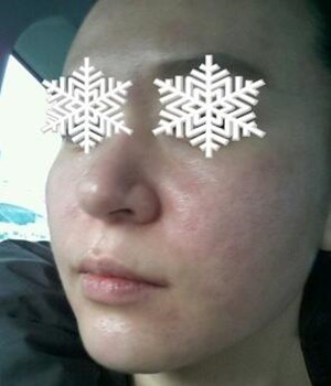 光子嫩膚后，整個人漂亮多了