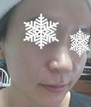 光子嫩膚后，整個人漂亮多了