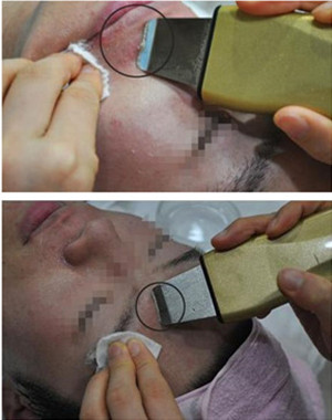 激光祛痘果怎么樣？激光祛痘前后過程對比圖