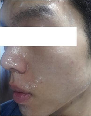 激光祛痘果怎么樣？激光祛痘前后過程對比圖