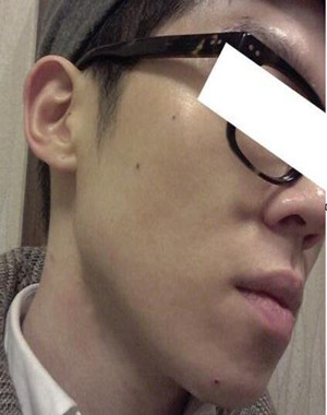 激光祛痘果怎么樣？激光祛痘前后過程對比圖