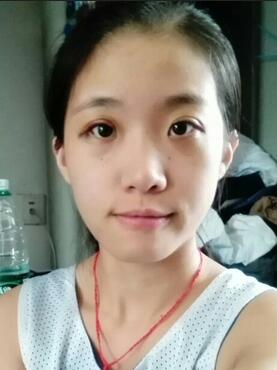 埋線雙眼皮15天恢復記錄