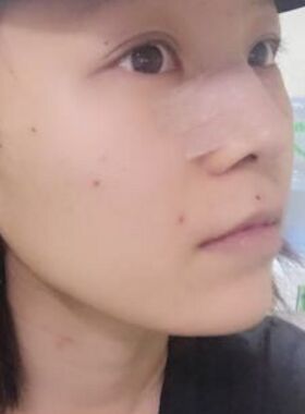 硅膠假體隆鼻給我?guī)沓每吹谋亲? /> </a>
										<a href=