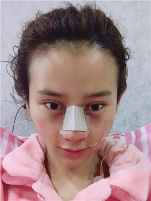 吳建明教授做的隆鼻整形 看起來還不錯