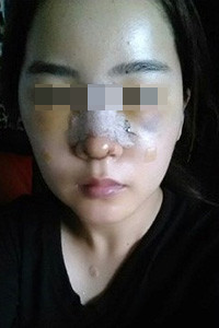 膨體隆鼻手術前后對比照片，真實案例分享！