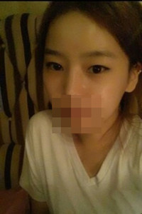 膨體隆鼻手術前后對比照片，真實案例分享！