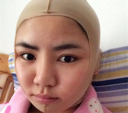 下頜角+顴骨手術前后過程以及真實果對比圖