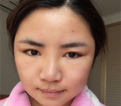 下頜角+顴骨手術前后過程以及真實果對比圖