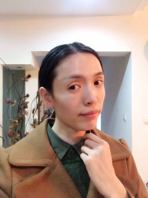 玻尿酸面部填充前后過程及對比圖片，來看看果如何