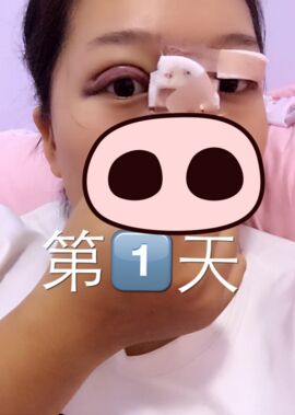 終于把雙眼皮割了，無錫菲尚張樹功做的