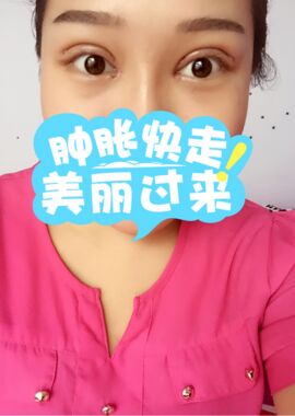 終于把雙眼皮割了，無錫菲尚張樹功做的