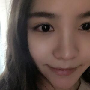 埋埋蛋白線.提升后臉上變得緊致許多，輪廓變得更好看