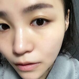 埋埋蛋白線.提升后臉上變得緊致許多，輪廓變得更好看