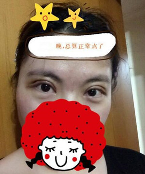 小眼睛變大眼睛 只需要一個(gè)全切雙眼皮