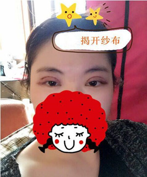 小眼睛變大眼睛 只需要一個(gè)全切雙眼皮