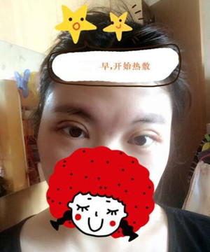 小眼睛變大眼睛 只需要一個(gè)全切雙眼皮