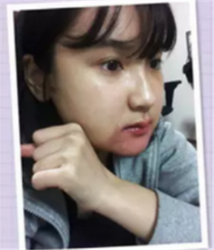 做了磨下頜角整形手術(shù)4個(gè)月了，曬曬我的恢復(fù)前后的對(duì)比照片吧~~