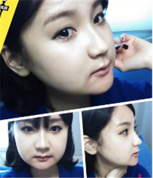 做了磨下頜角整形手術(shù)4個(gè)月了，曬曬我的恢復(fù)前后的對(duì)比照片吧~~