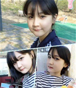 做了磨下頜角整形手術(shù)4個(gè)月了，曬曬我的恢復(fù)前后的對(duì)比照片吧~~