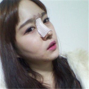 分享我改臉型+硅膠隆鼻手術(shù)前后對(duì)比果照片，伊萊美李湘源做的~