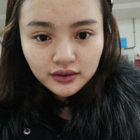 玻尿酸隆鼻花了兩萬(wàn)多果很自然哦，值~！